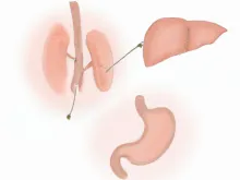 Chirurgia hepato-bilio-pancreatică: colecistectomia illustratie