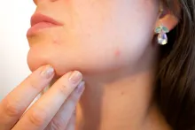Obezitatea şi afecţiunile dermatologice